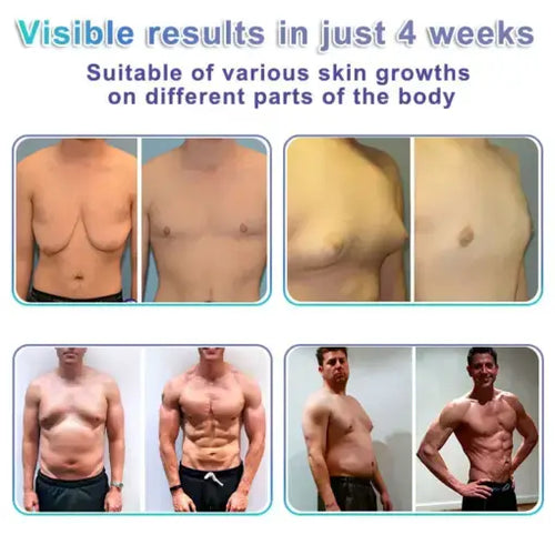 NanoMedix Gynecomastia Chest Fatburn & Firm Patch