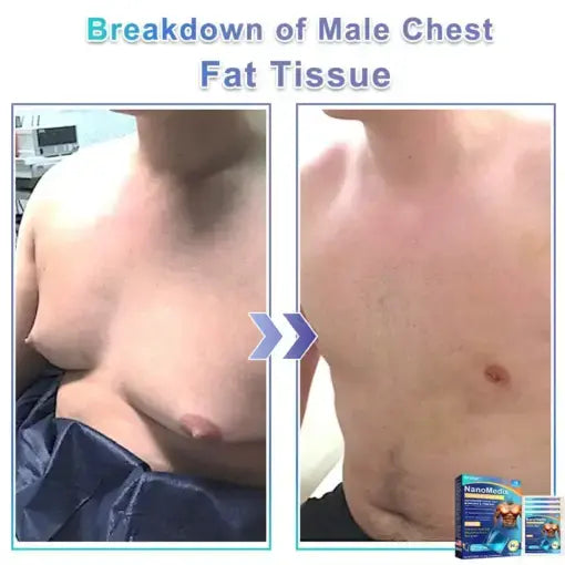 NanoMedix Gynecomastia Chest Fatburn & Firm Patch